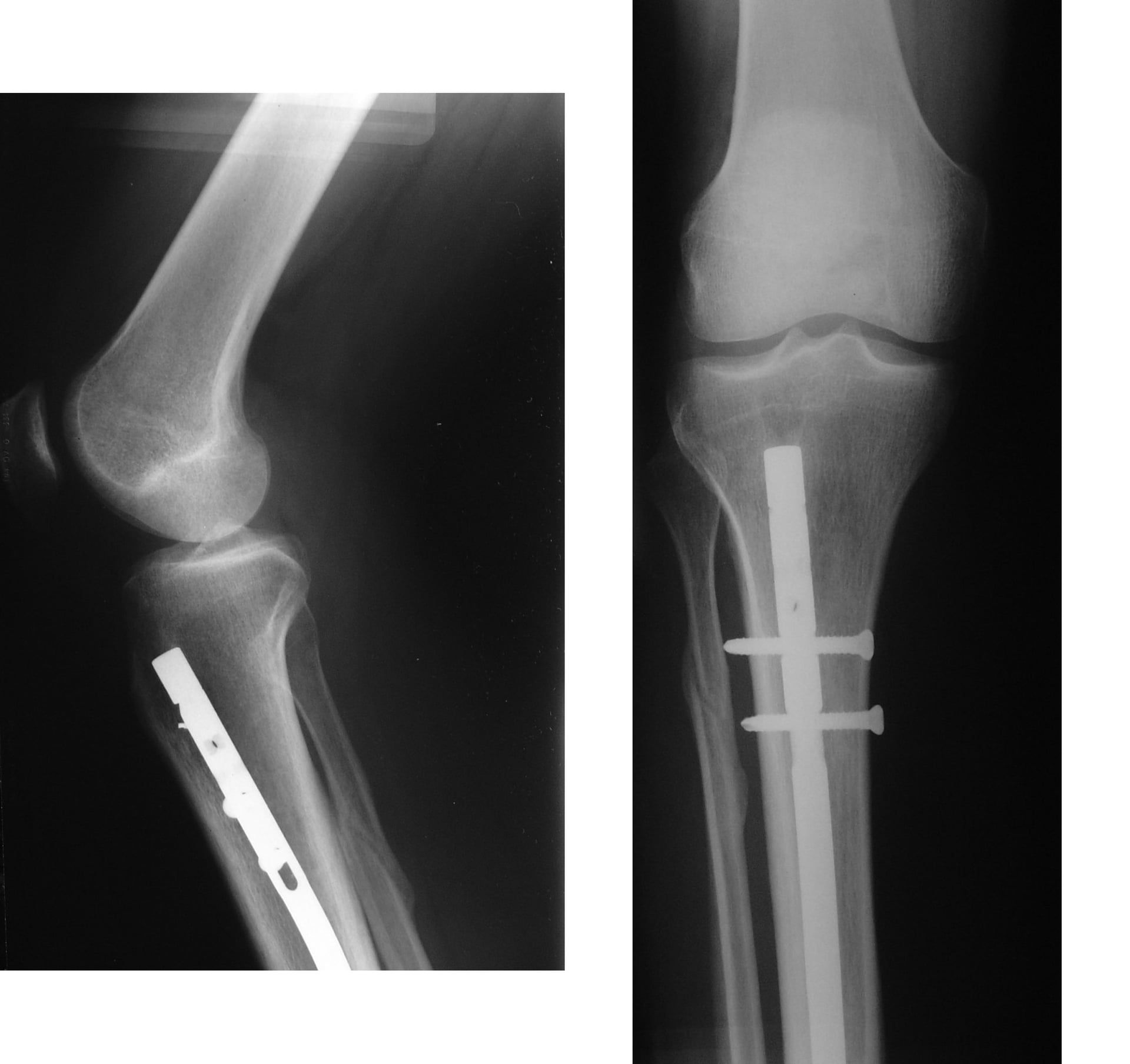 Tibial shaft fracture fixed with a locked intramedullary nail