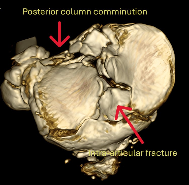 Axial three-dimensional CT reconstruction of a tibial plateau with arrows labelled posterior column comminution and intra-articular fracture