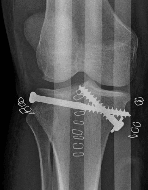 Tibial plateau fracture fixed with buttress plate and raft screws