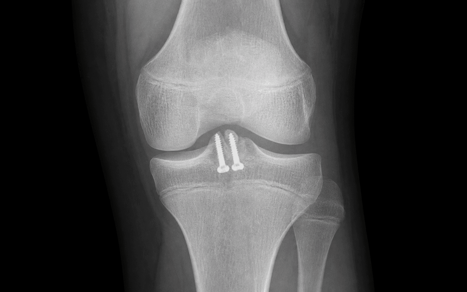 AP knee radiograph of a fixed tibial eminence fracture