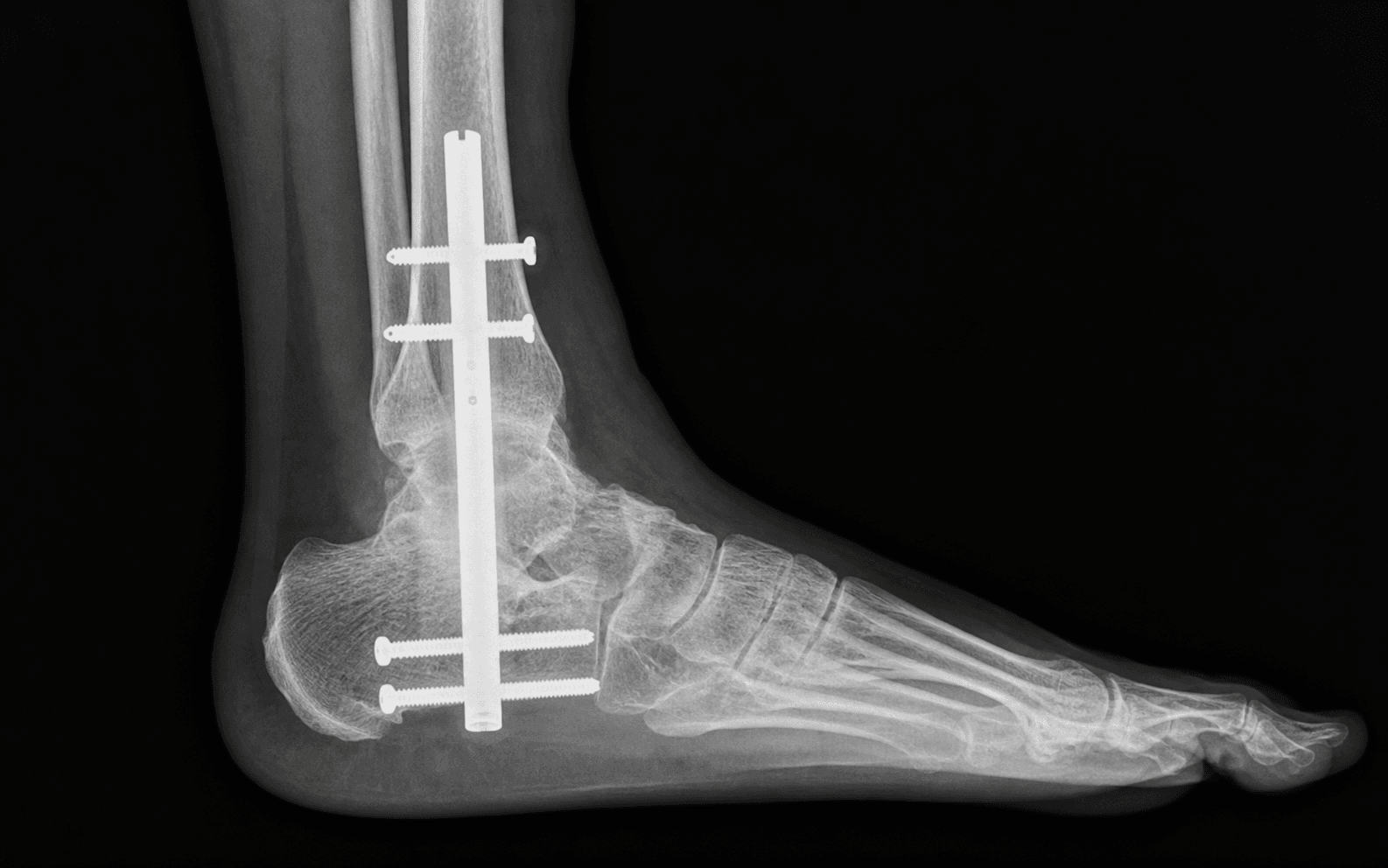 Tibiotalocalcaneal arthrodesis with retrograde nail