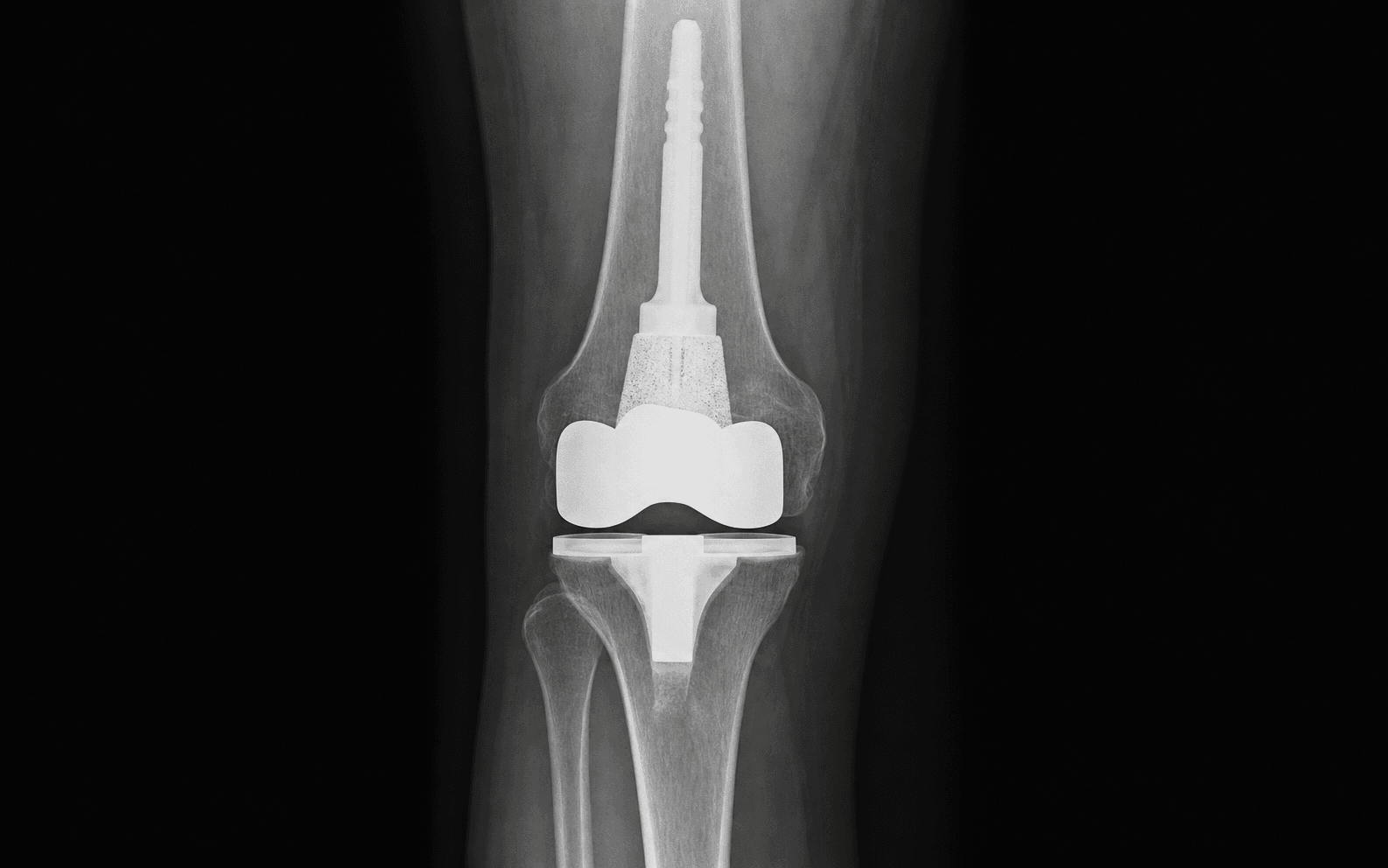 AP knee radiograph of a revision TKA femoral component