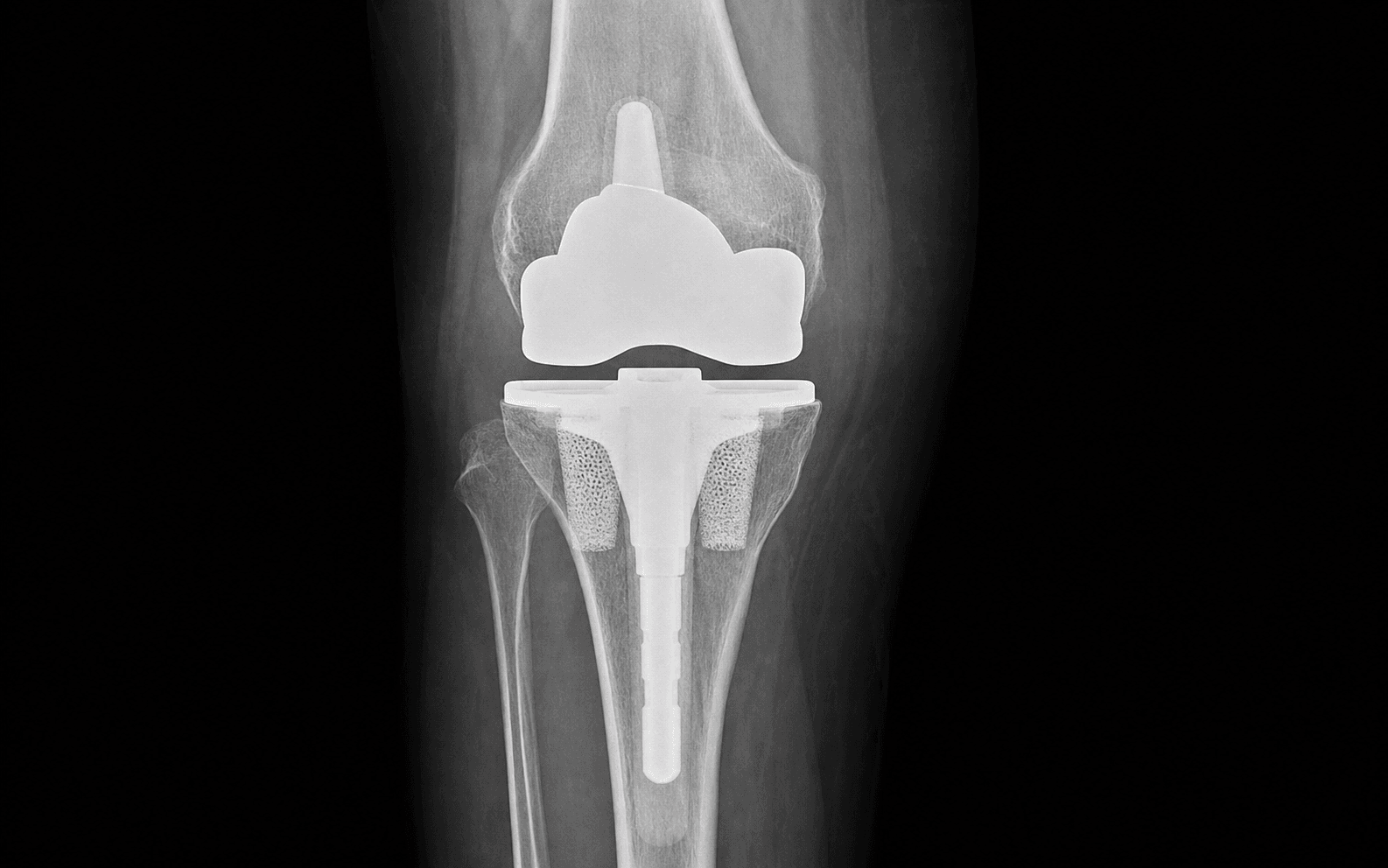 AP knee radiograph of a revision TKA tibial component with cone