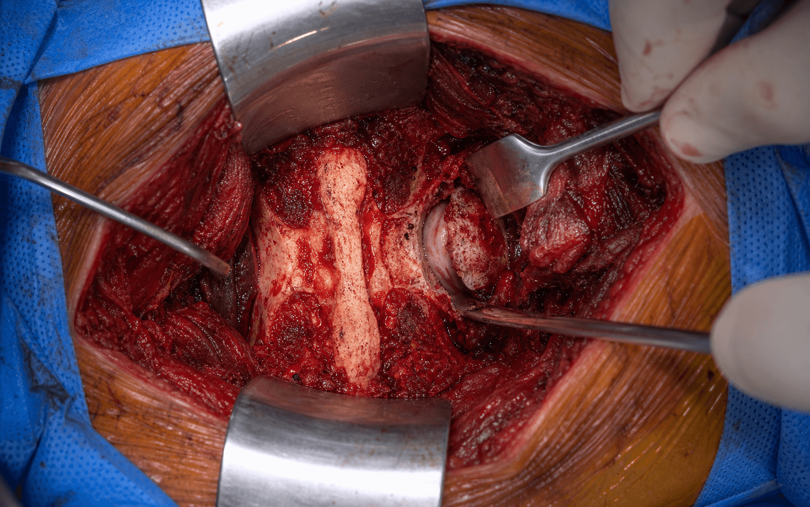 Intra-operative photograph of the TLIF exposure