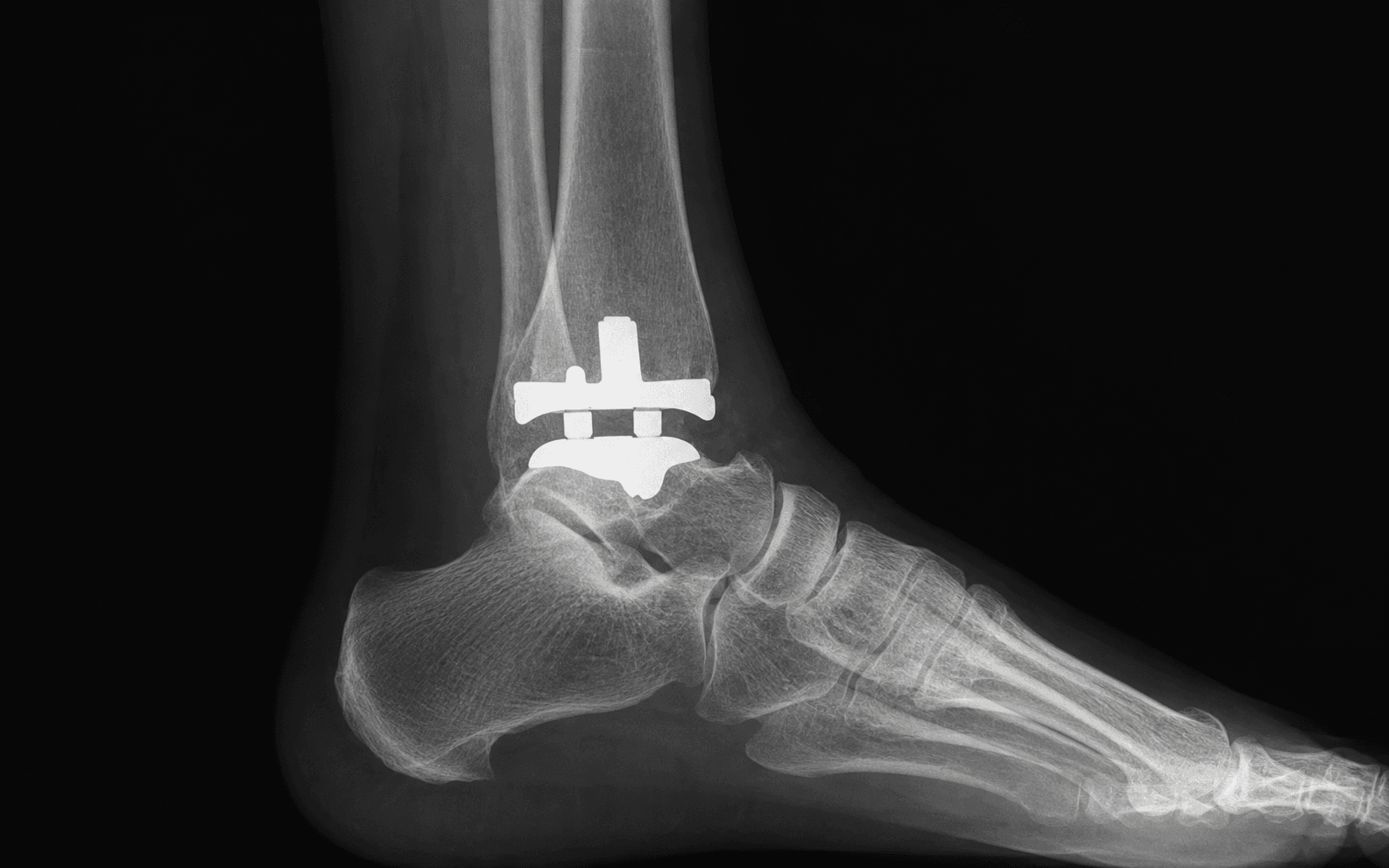 AP ankle radiograph after total ankle replacement