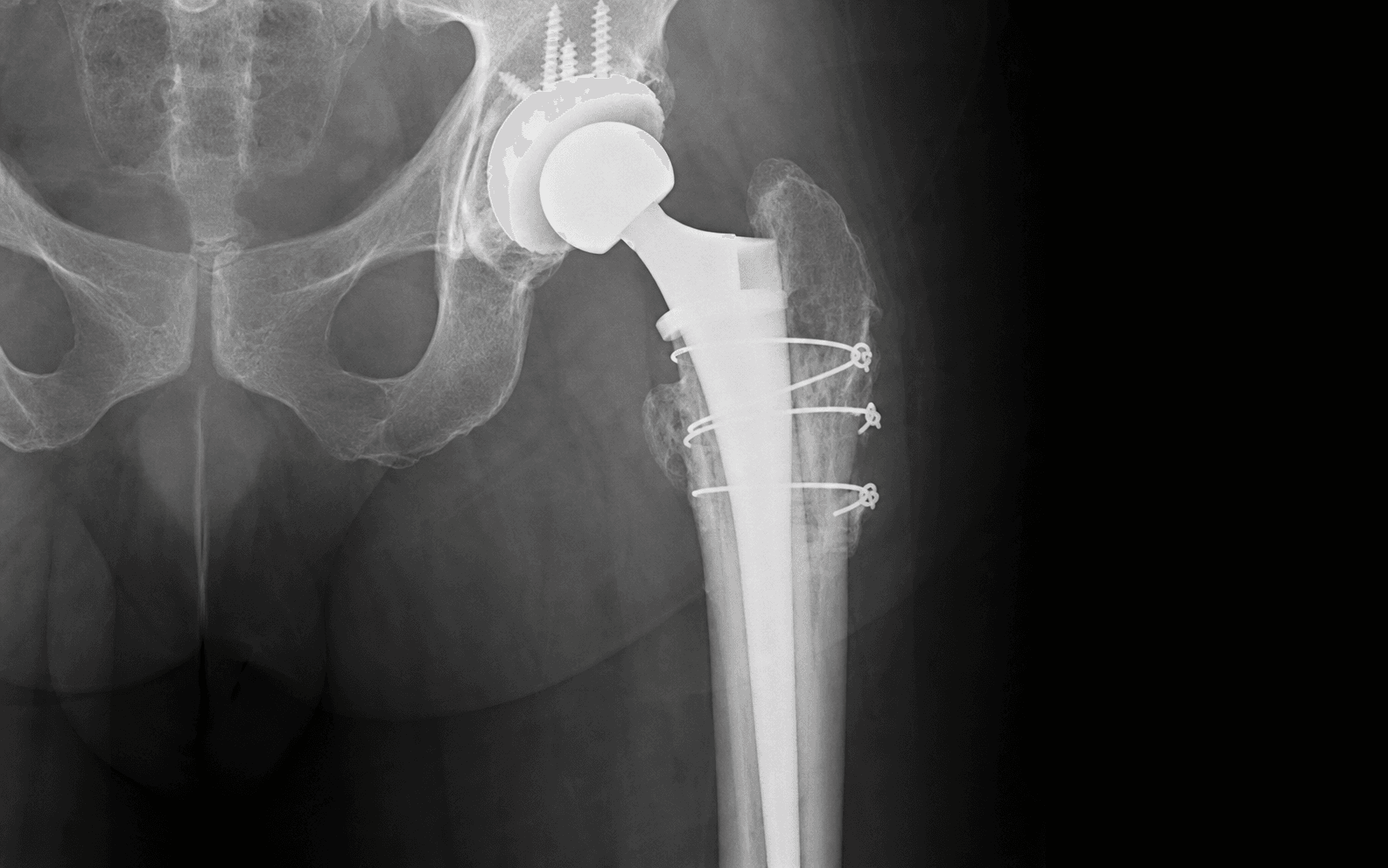 AP hip radiograph of a revision THA through an extended trochanteric osteotomy