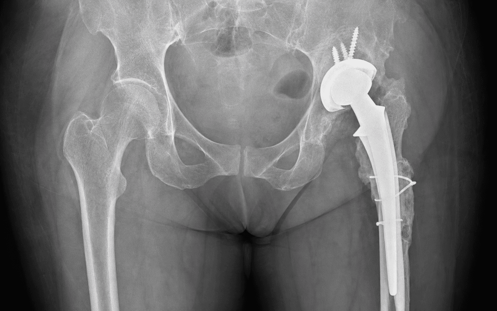 AP hip radiograph during two-stage revision for an infected hip replacement