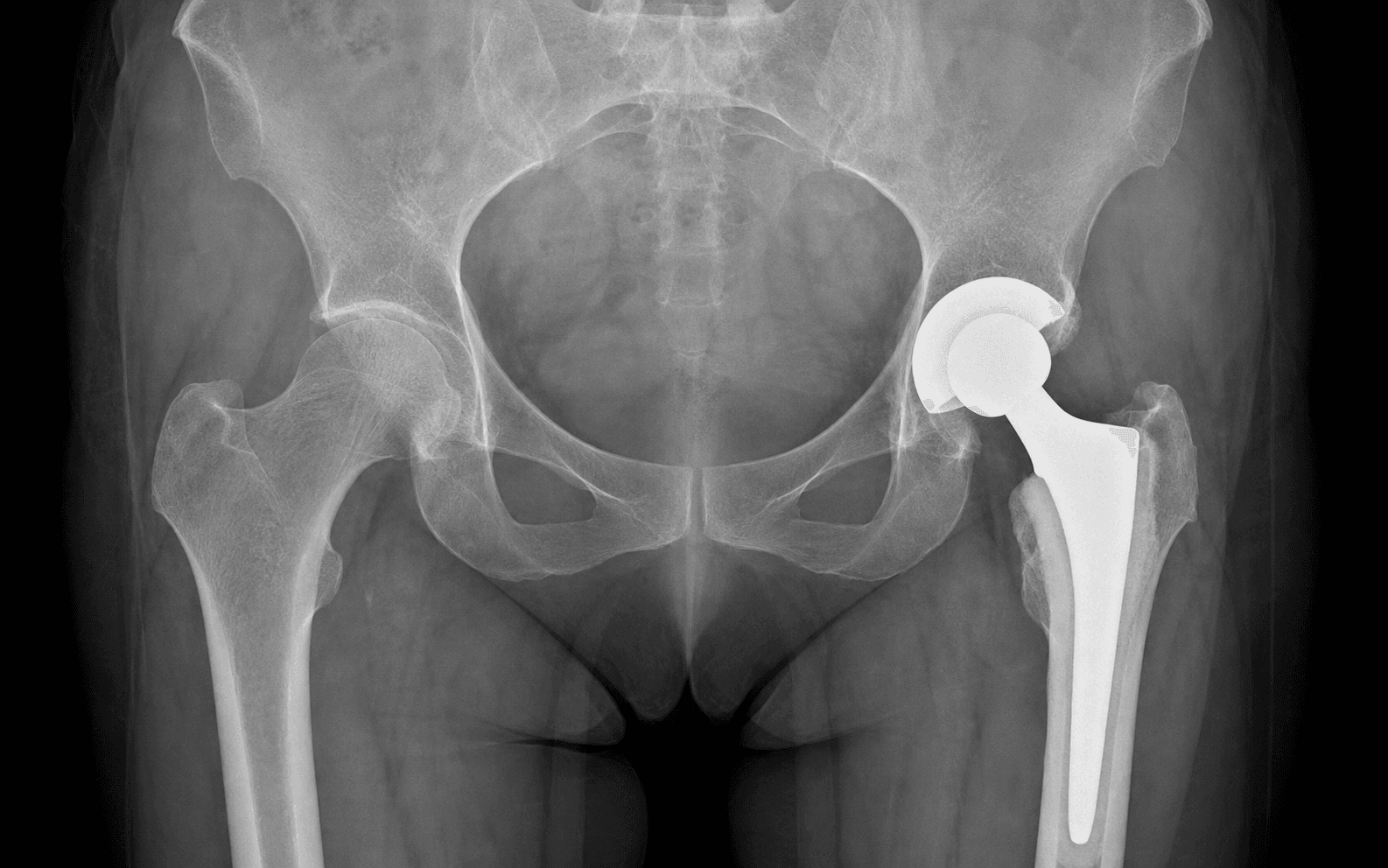 AP pelvic radiograph of a cemented total hip replacement