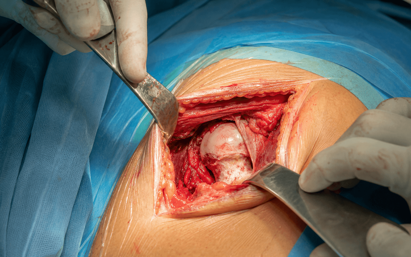 Intra-operative photograph of the direct anterior approach to the hip