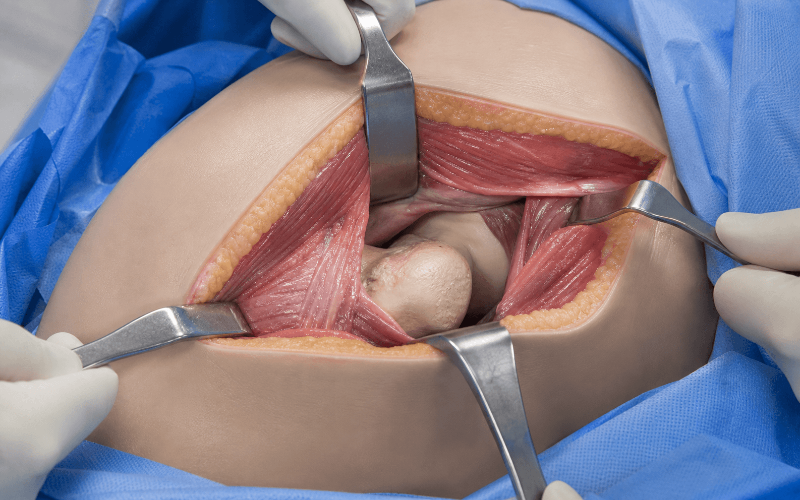 Intra-operative direct lateral approach to the hip