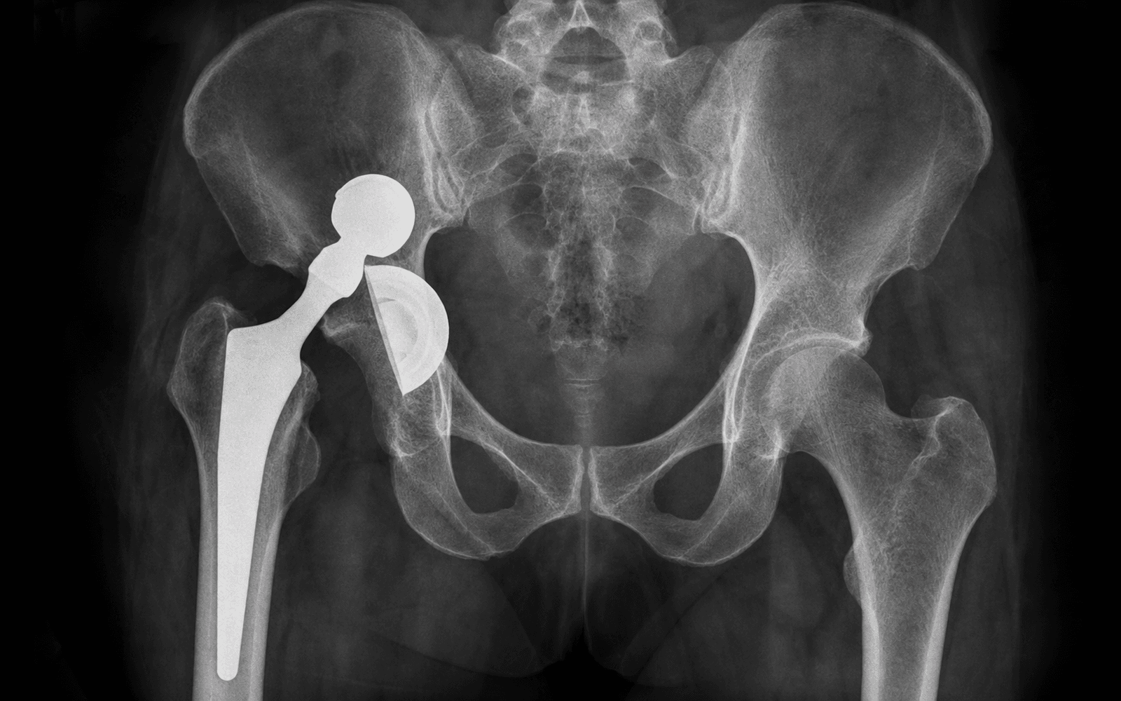 AP pelvic radiograph of a dislocated hip replacement