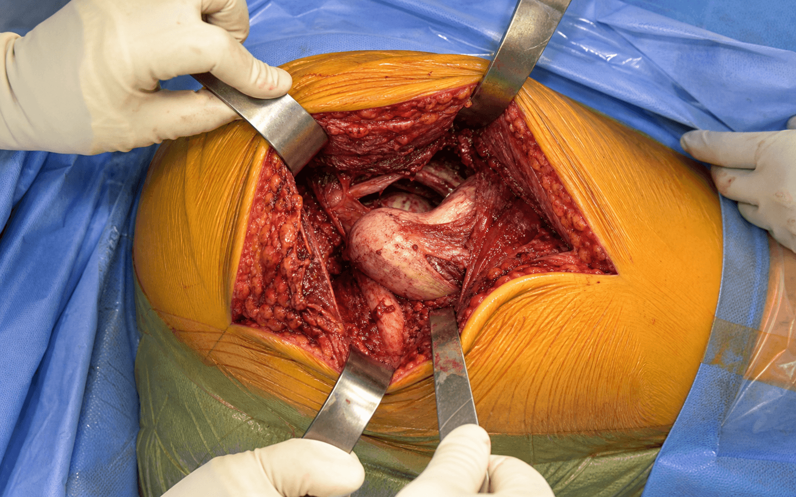 Intra-operative posterior approach to the hip