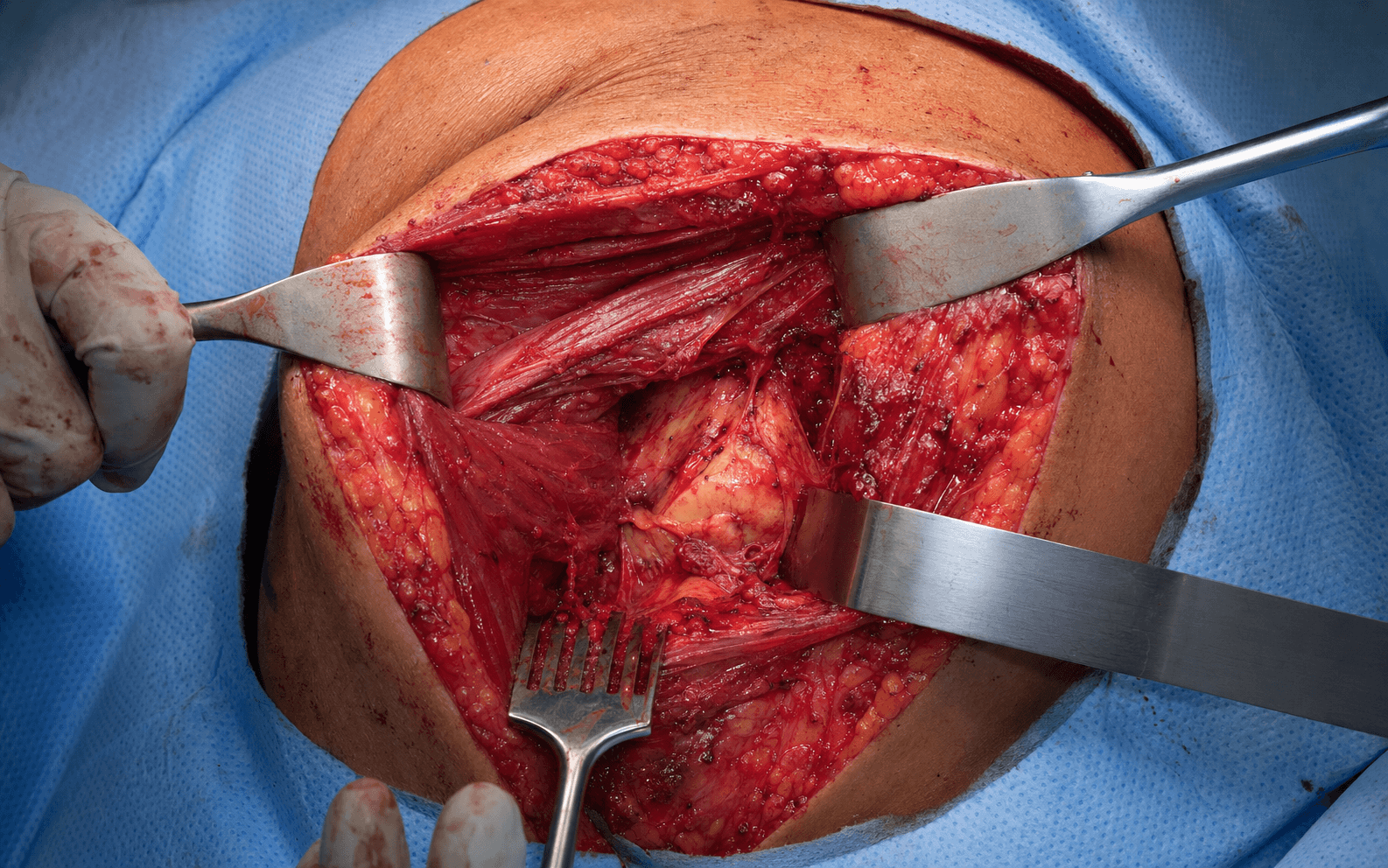 Intra-operative tissue-sparing posterior approach to the hip