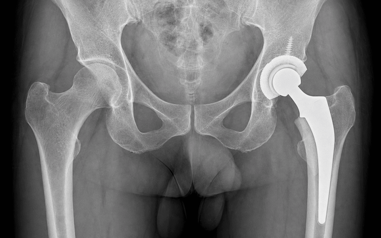AP pelvic radiograph of a hip replacement with a ceramic bearing