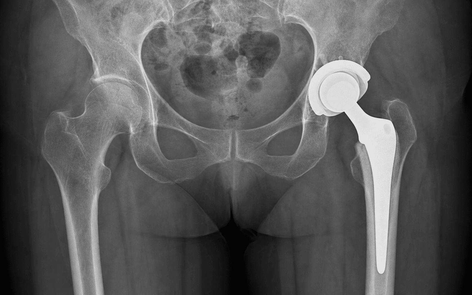 AP pelvic radiograph of a dual-mobility hip replacement