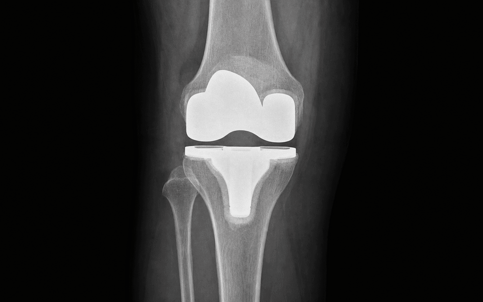 AP knee radiograph of a cemented total knee replacement