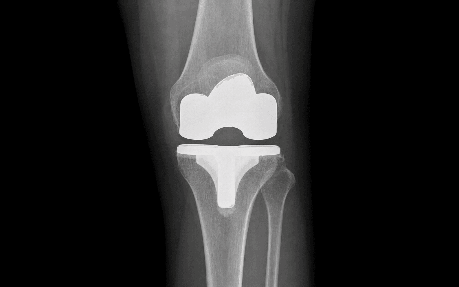AP knee radiograph of a total knee replacement for valgus deformity