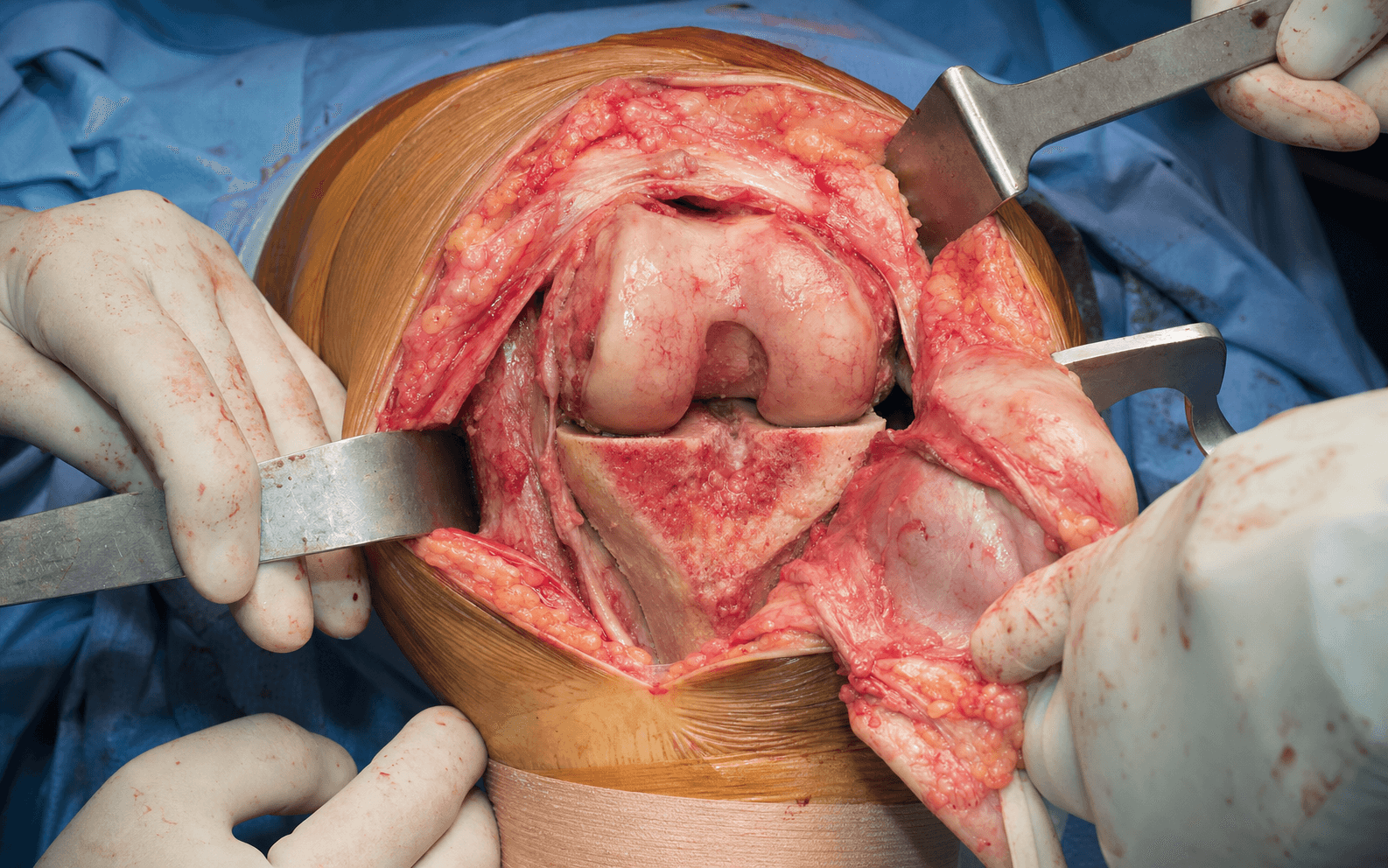 Intra-operative medial parapatellar approach to the knee