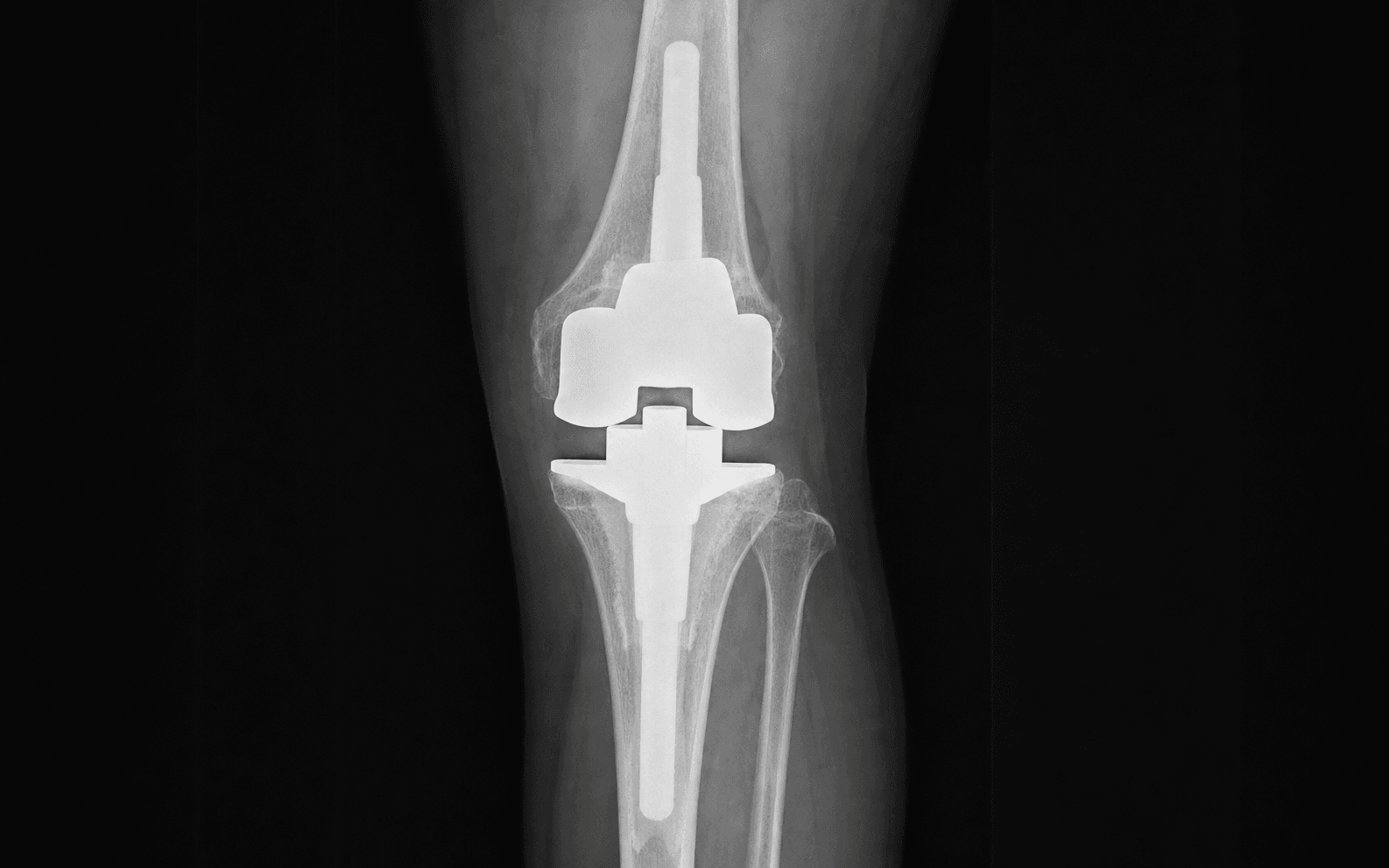 AP knee radiograph of a constrained total knee replacement