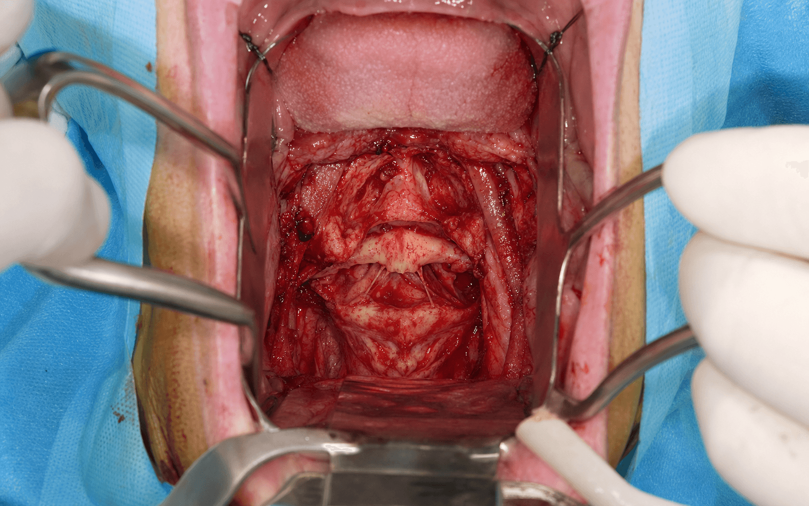 Intra-operative transoral exposure of the upper cervical spine