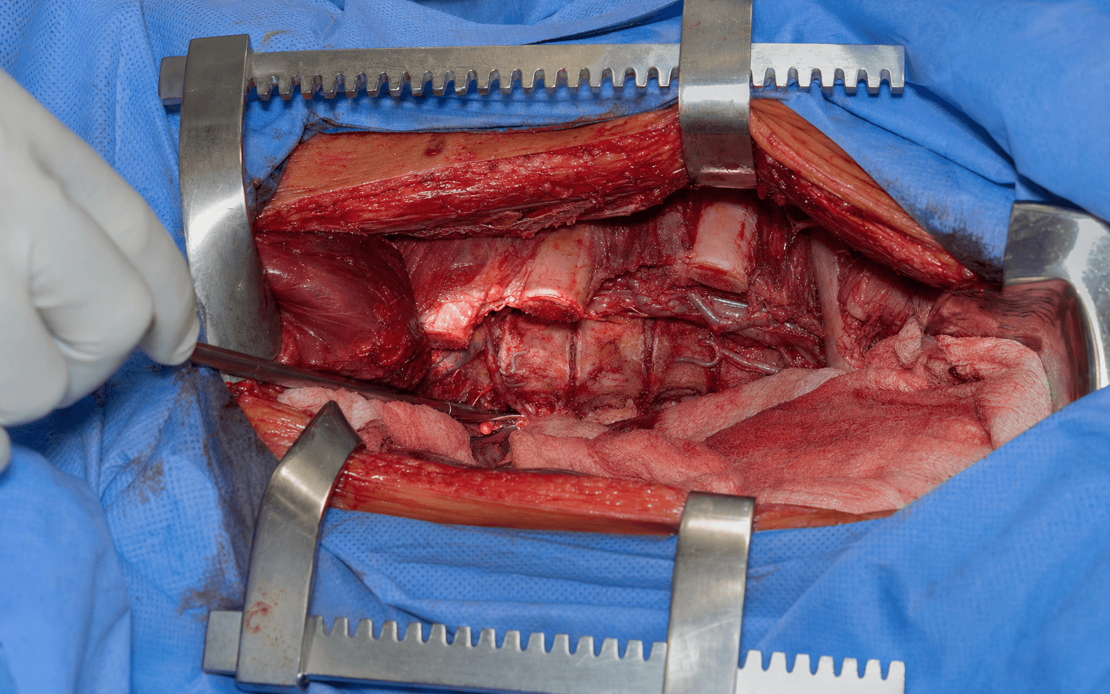 Intra-operative transthoracic approach to the spine