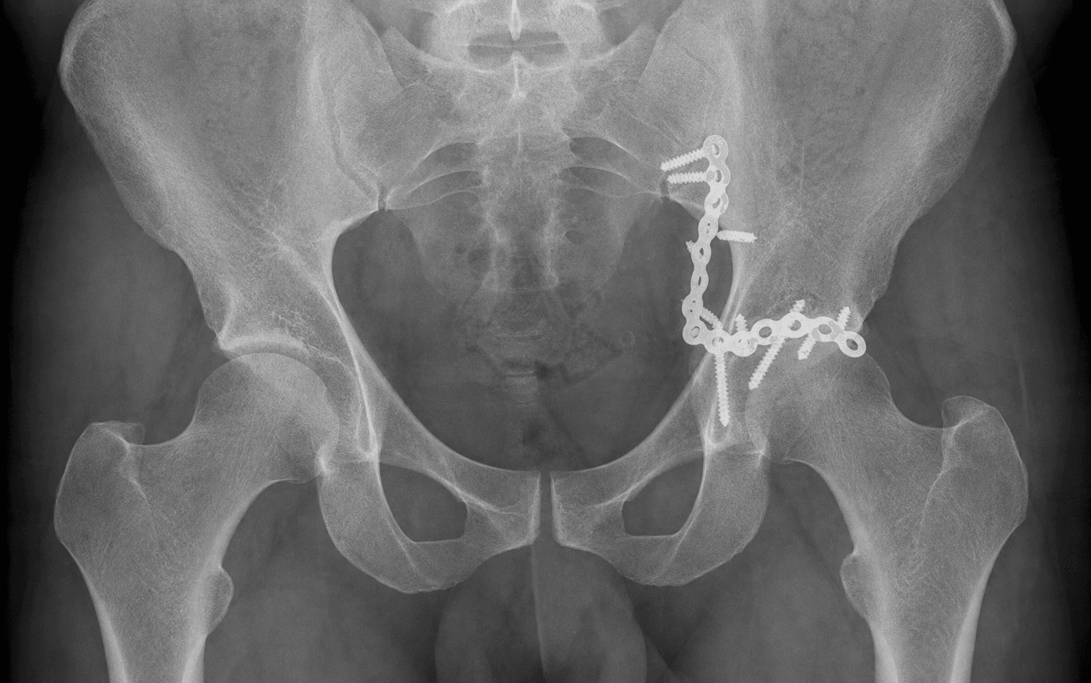 AP pelvic radiograph after acetabular fracture fixation