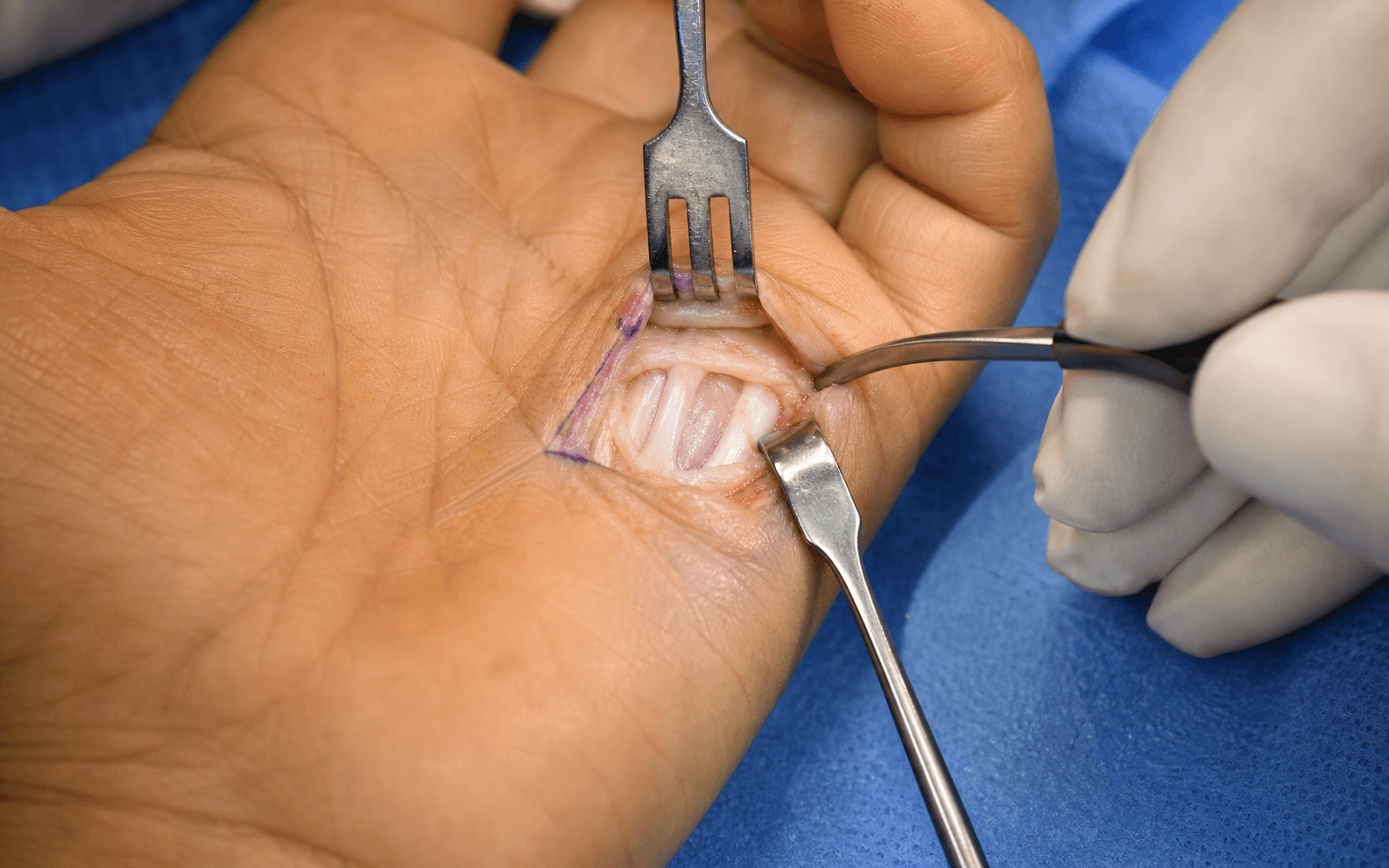 Intra-operative A1 pulley release for trigger finger