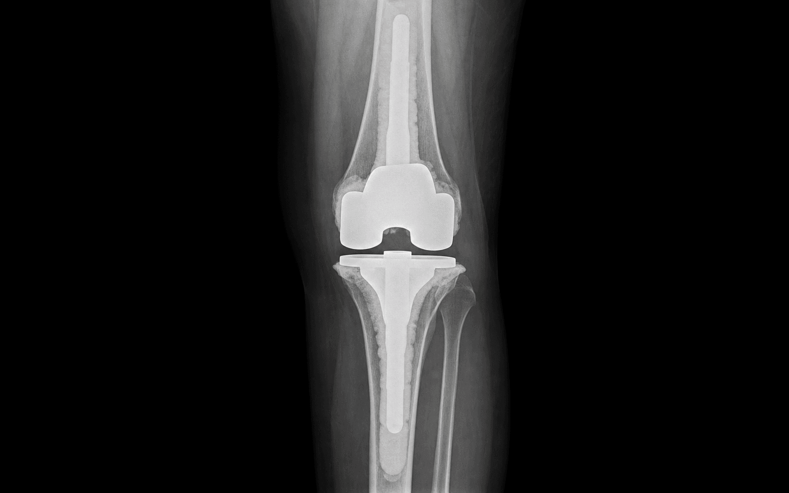 AP knee radiograph of a reimplanted total knee replacement