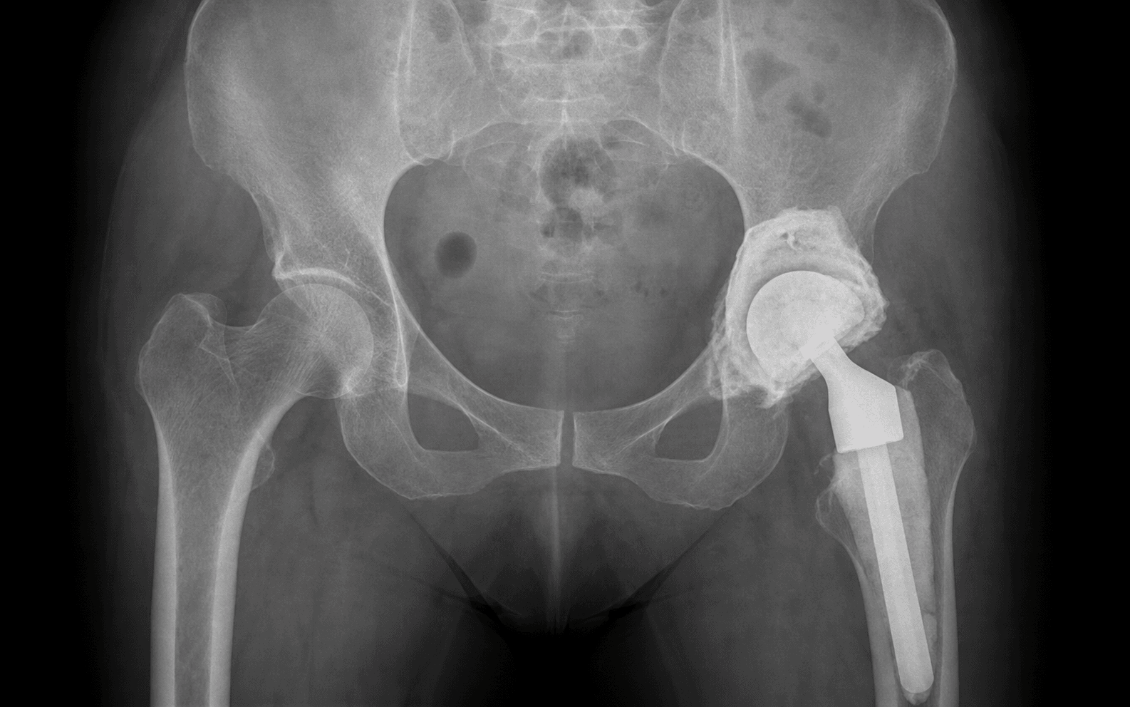 AP pelvic radiograph of an antibiotic cement hip spacer