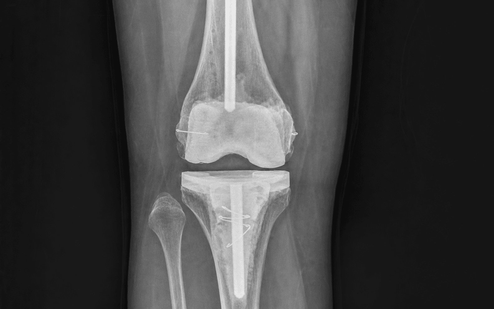 AP knee radiograph of an articulating antibiotic cement knee spacer