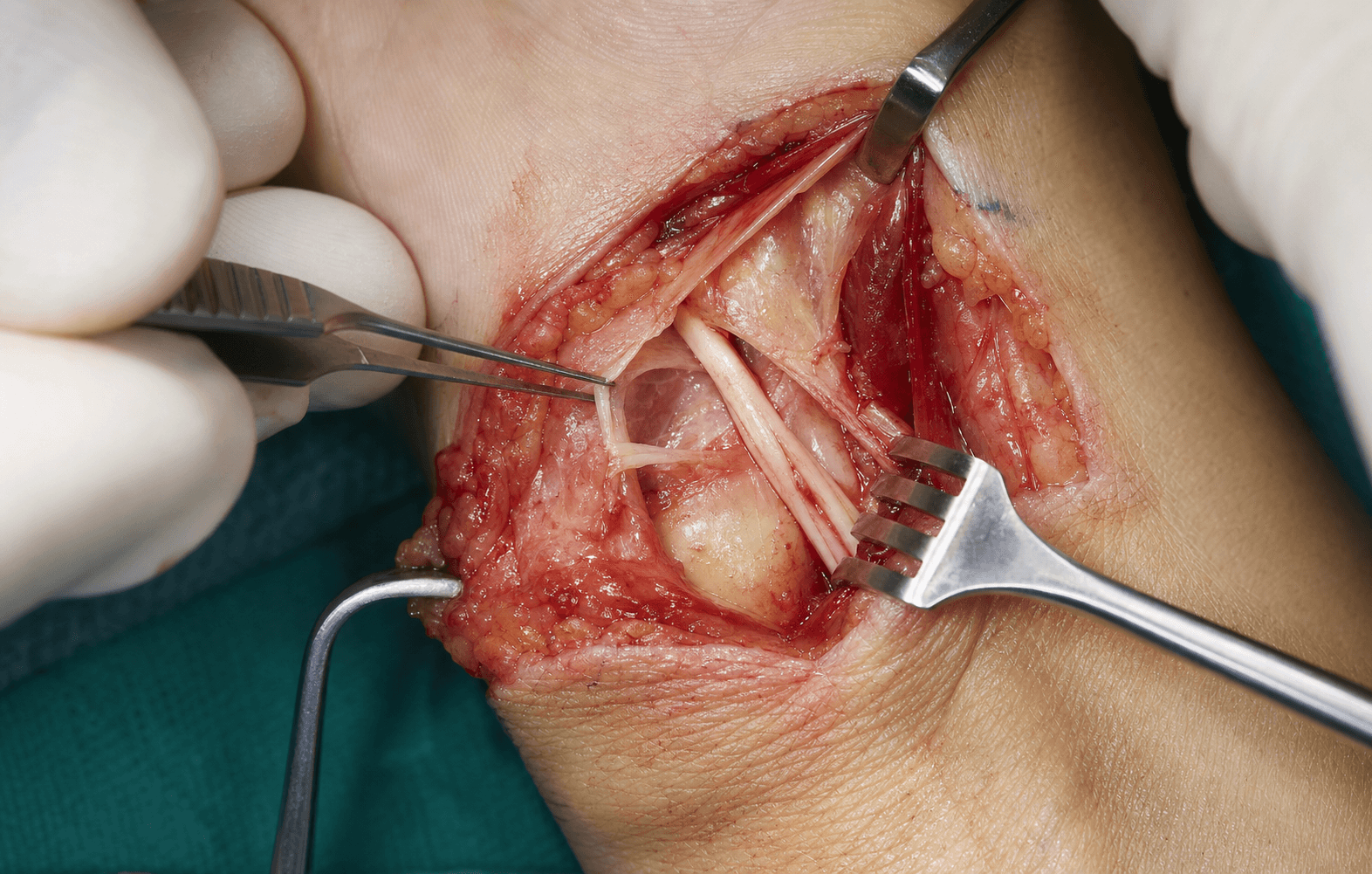 Intra-operative decompression of the ulnar nerve at Guyon's canal