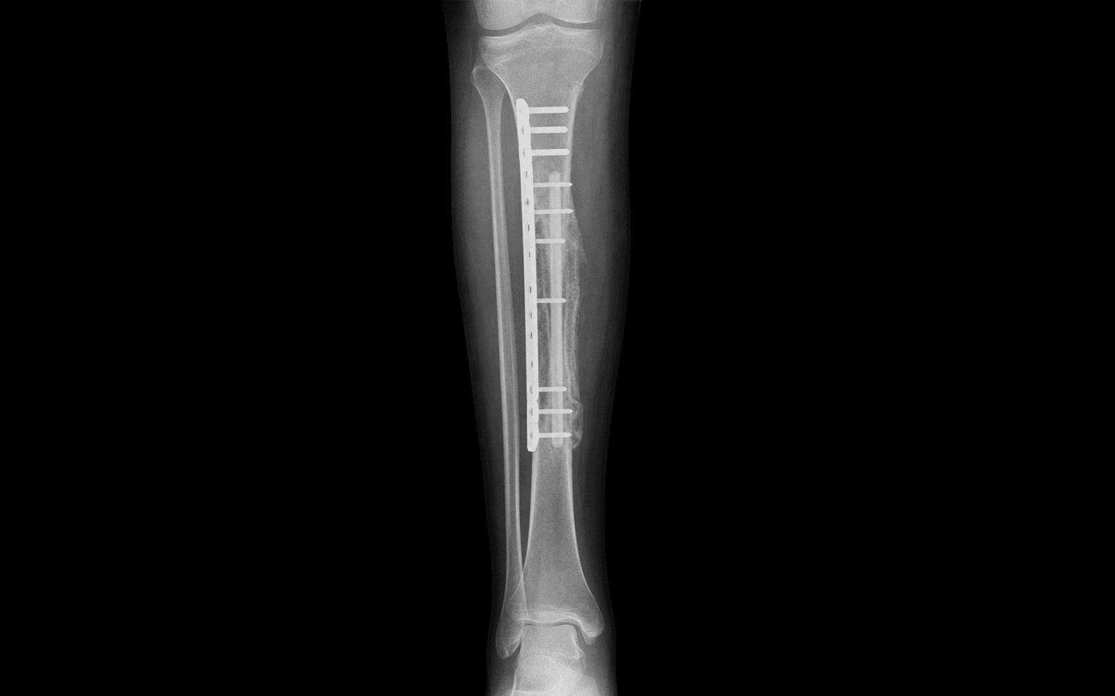 Vascularised fibular graft reconstructing a tibial defect