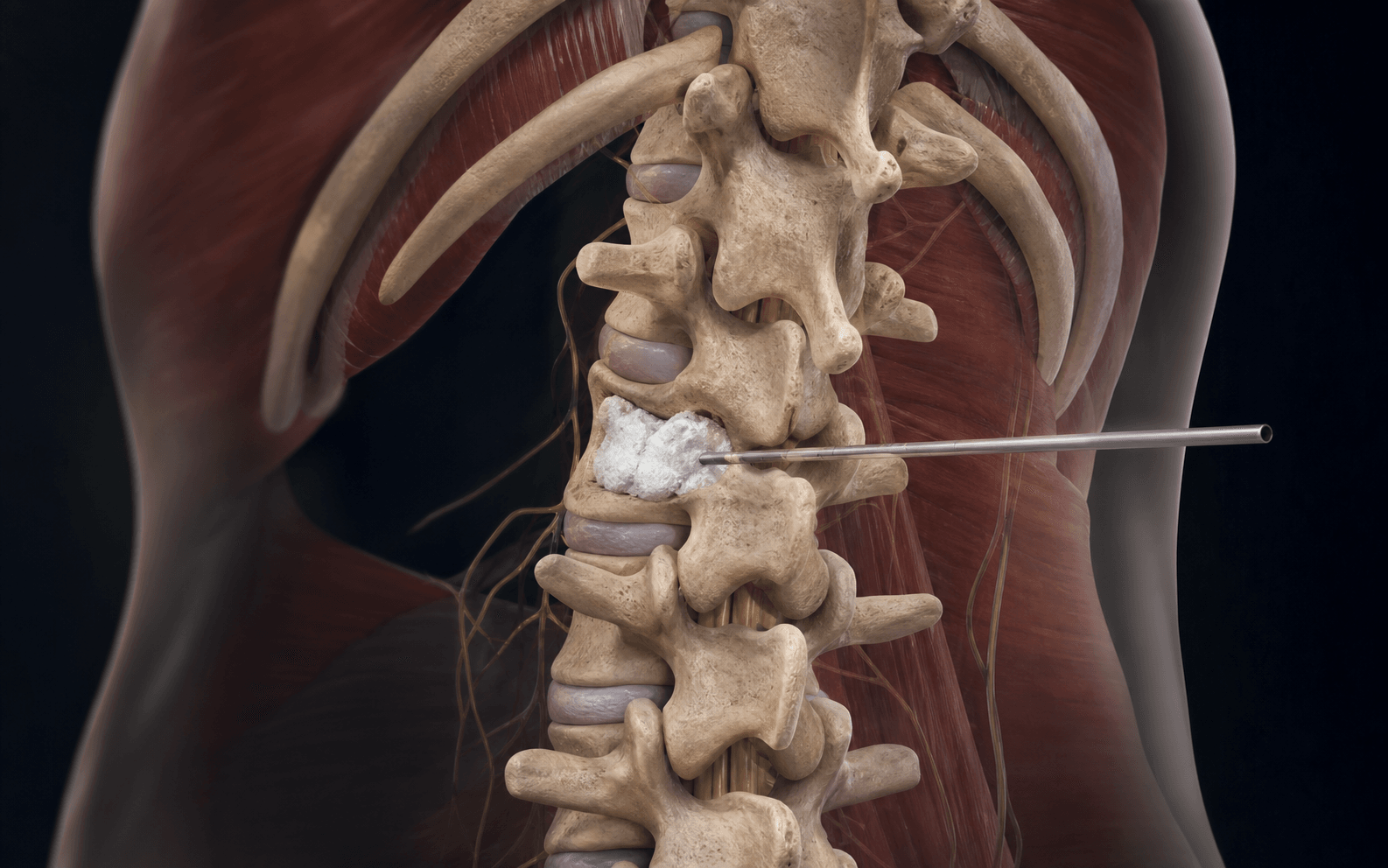 Illustration of percutaneous vertebroplasty cement injection