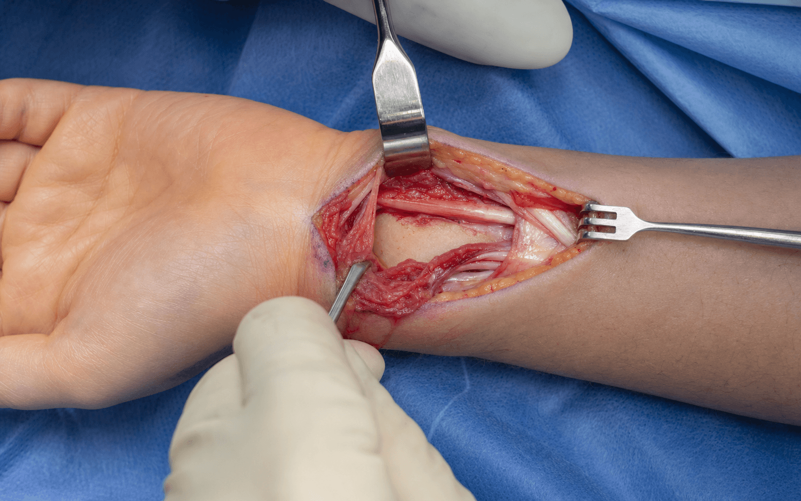 Intra-operative volar approach to the distal radius