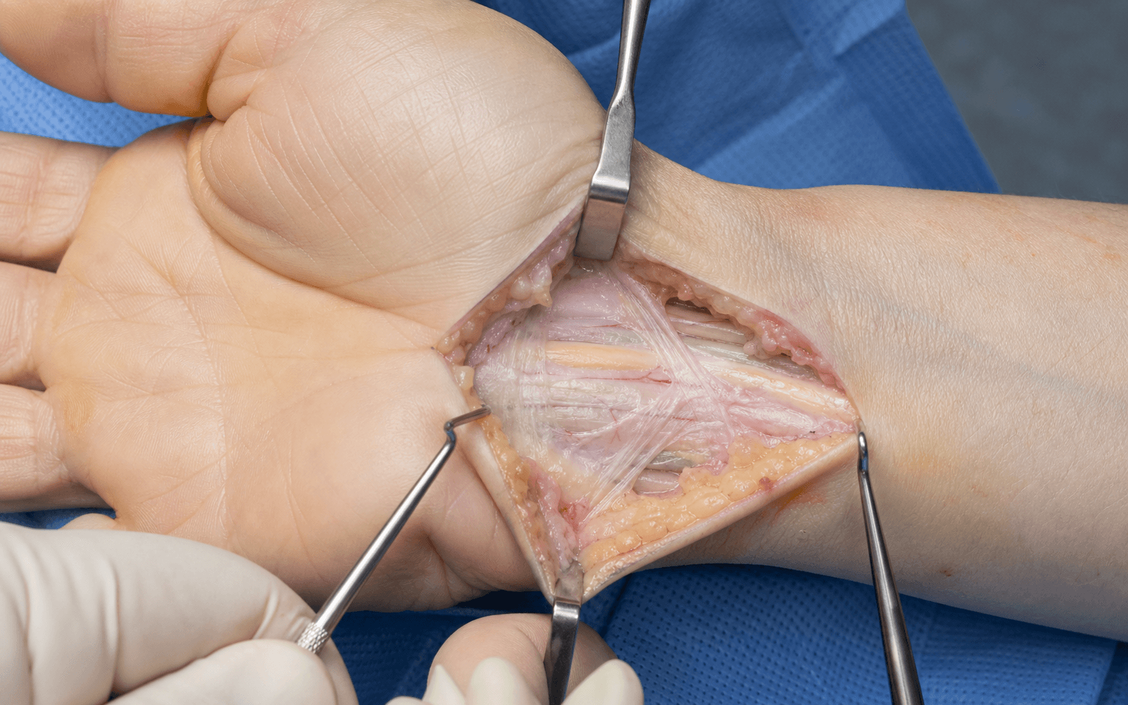 Intra-operative exposure of the carpal canal