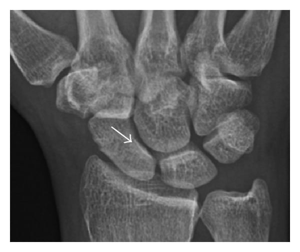 PA wrist radiograph; the arrow indicates a fracture through the scaphoid waist — the classic indication for the volar approach.