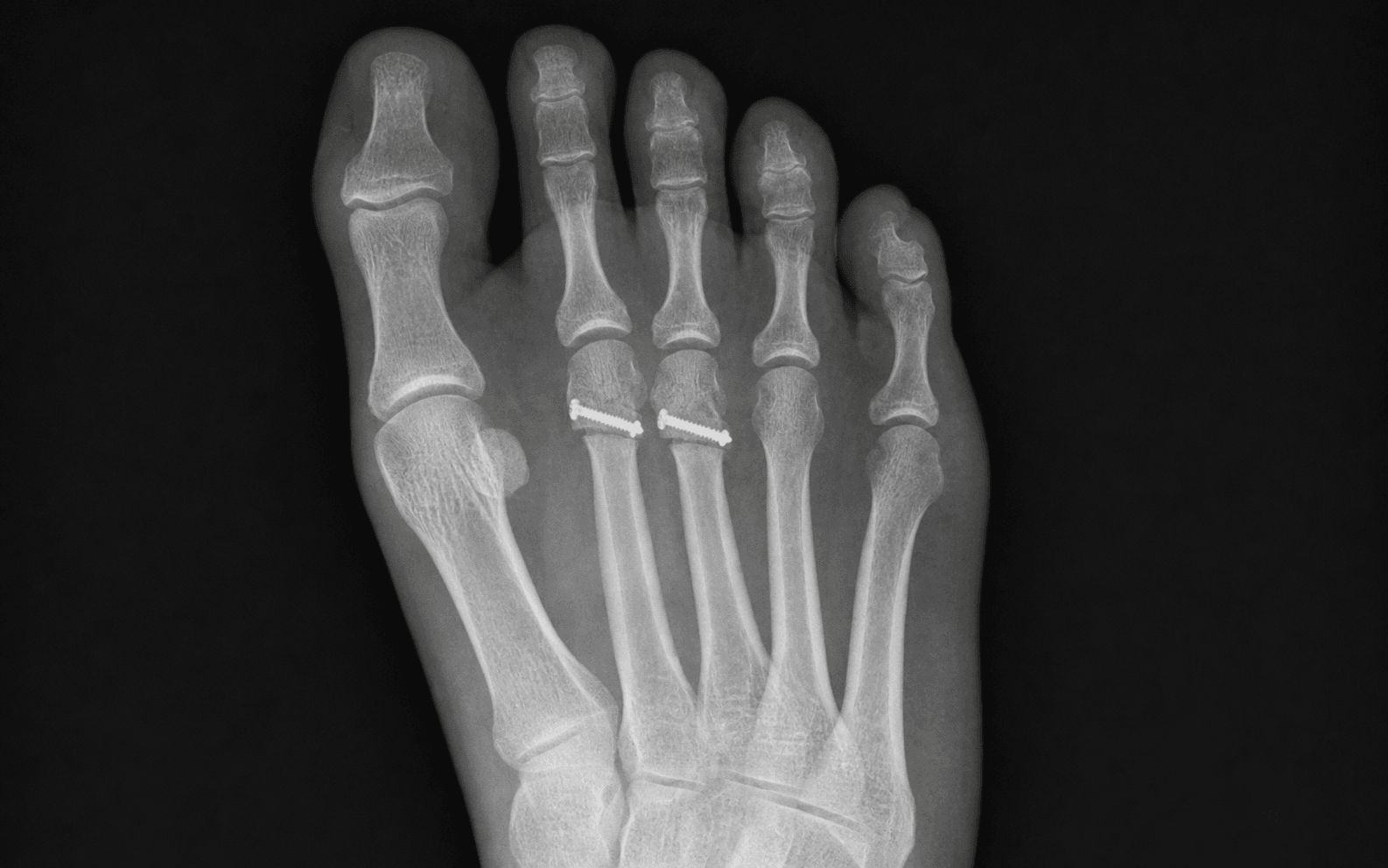 Dorsoplantar foot radiograph after Weil osteotomies