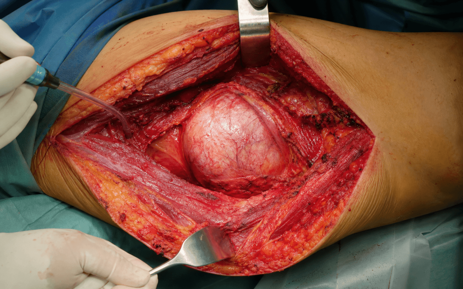 Intra-operative wide local excision of a soft-tissue tumour