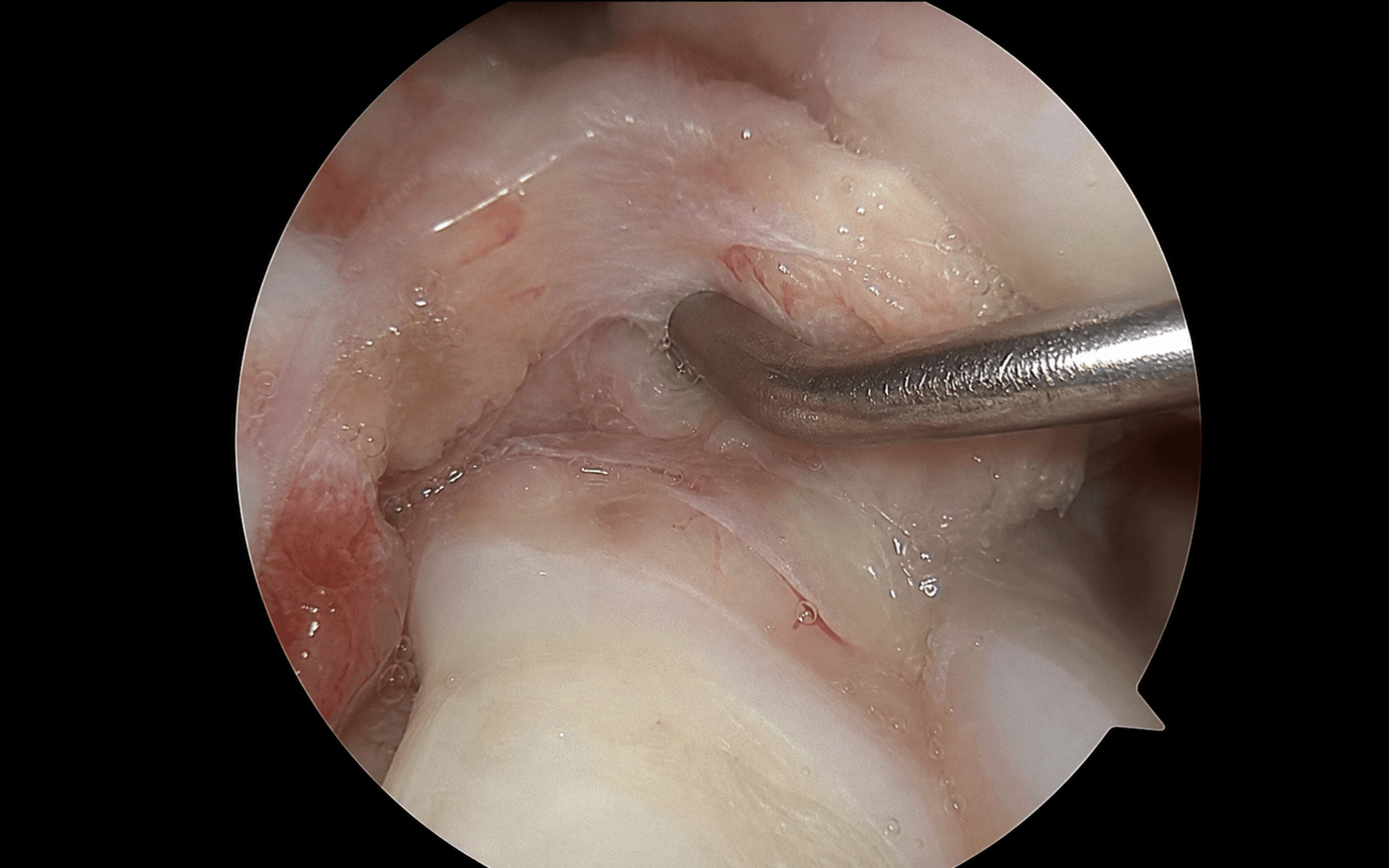 Arthroscopic view of the wrist