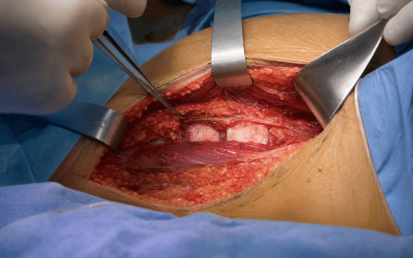Intra-operative lateral transpsoas exposure of the lumbar spine