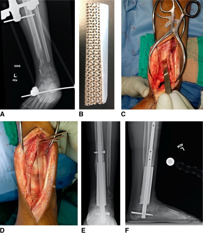 Clinical case of tibial bone defect reconstruction with 3D printed implant