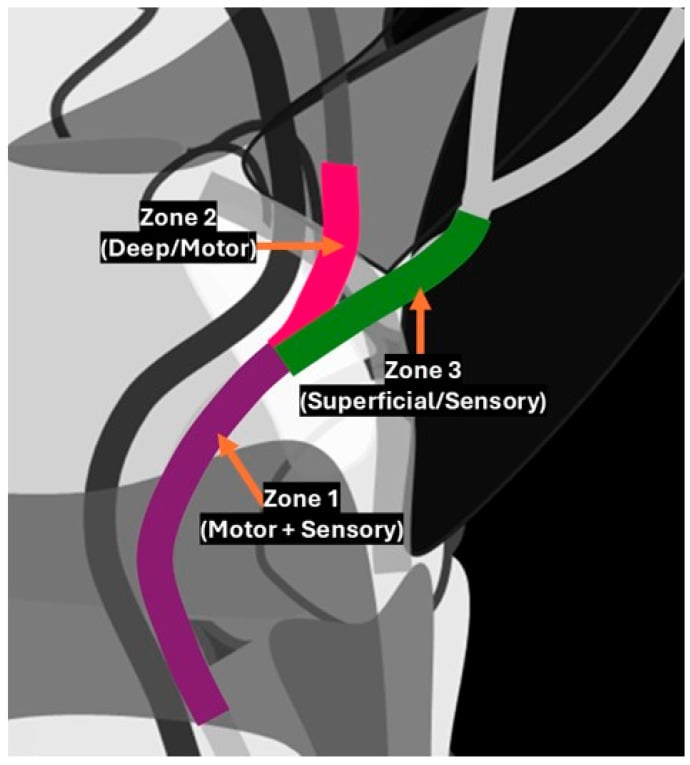 Three zones of Guyon's canal classification