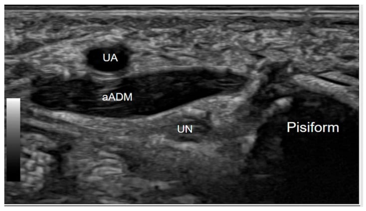 Ultrasound showing accessory abductor digiti minimi muscle