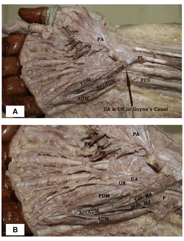 Palmar cadaveric dissection showing abductor digiti minimi and an accessory abductor digiti minimi beside the ulnar nerve and artery in Guyon canal