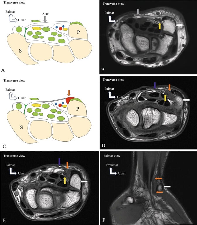Transverse schematics and MR images, with a palmar-view image, comparing normal Guyon canal anatomy with a fascial-type accessory abductor digiti minimi