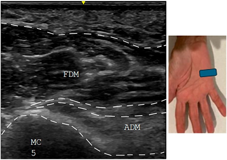 Short-axis hypothenar ultrasound showing increased echogenicity of abductor digiti minimi after injury