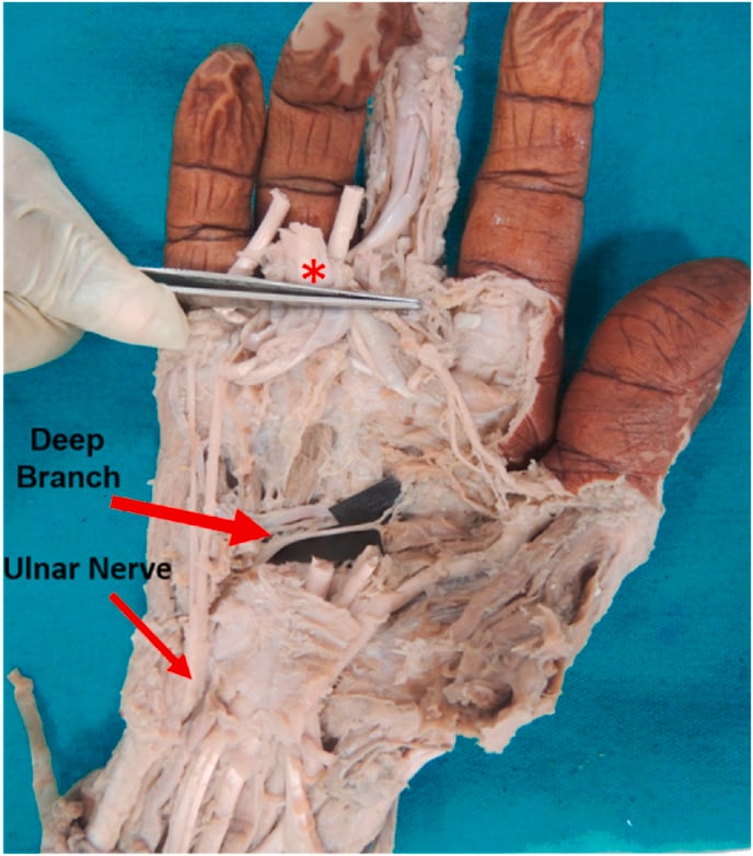 Palmar cadaveric dissection showing the ulnar nerve and its deep motor branch traversing the palm