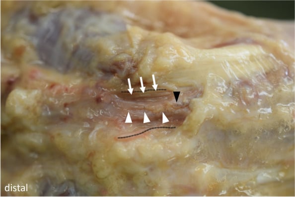 Cadaveric Guyon canal after palmar carpal ligament release, with arrows, arrowheads and dotted lines marking the exposed structures