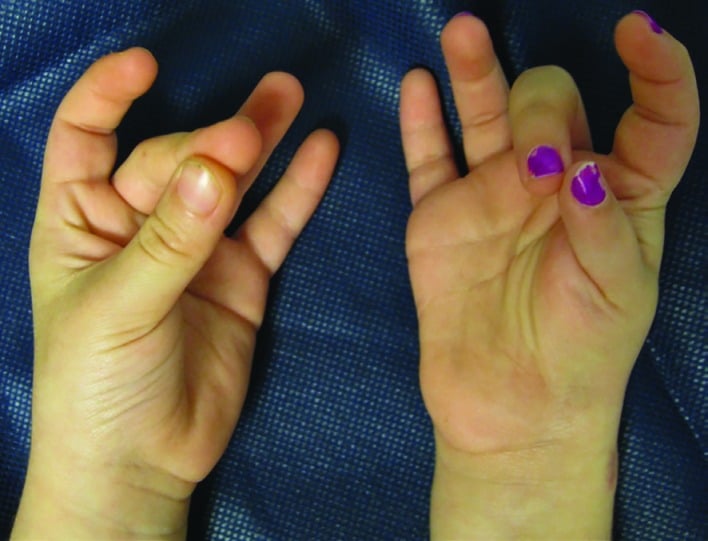 Postoperative photograph of both hands with each thumb opposed to a fingertip after Huber abductor digiti minimi transfer