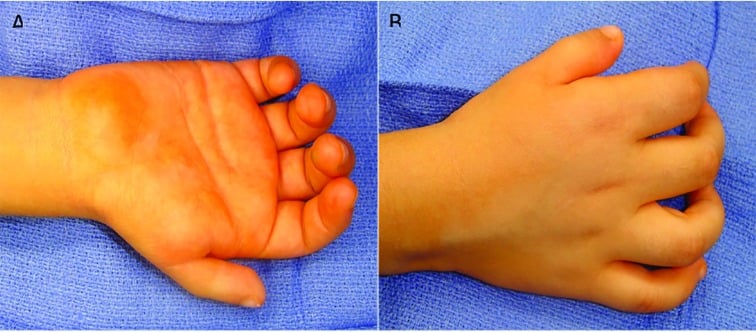 Volar and dorsal photographs of a hypoplastic thumb before Huber abductor digiti minimi opposition transfer